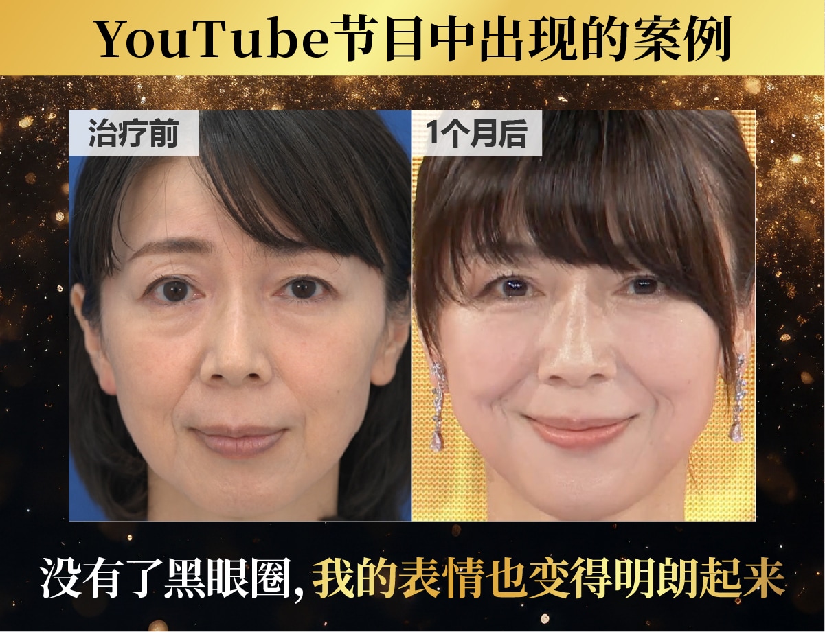 去黑眼圈案例:50 岁出头,女性。