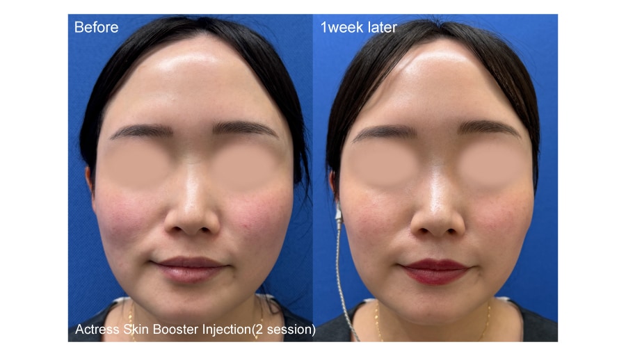 Diagnosis: Actress Skin Booster Injection