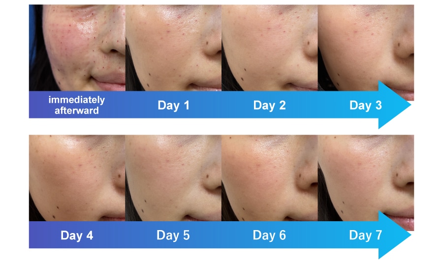 Downtime varies from person to person.