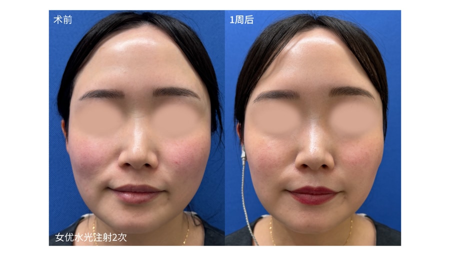 诊断结果:女优水光注射