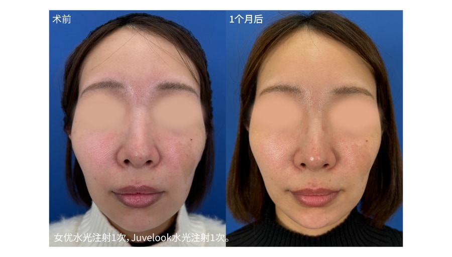 诊断结果：Juvelook水光注射
