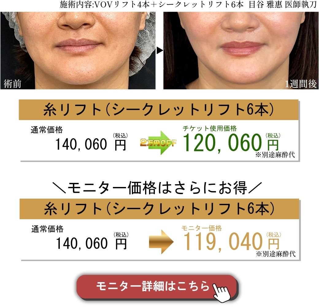 糸リフト症例