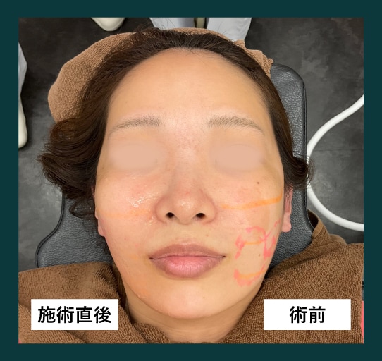 1回でも効果を即実感