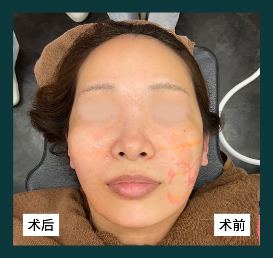 一次治疗即可立即感受效果