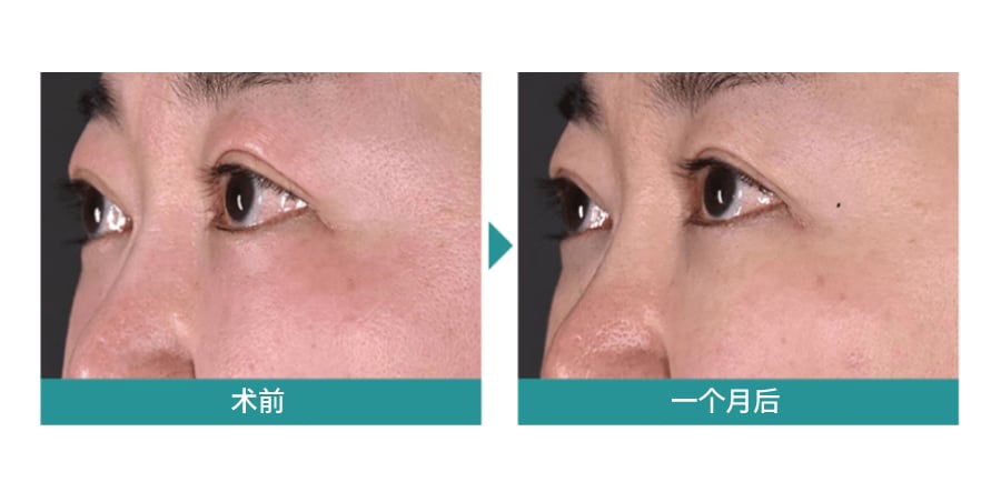 使用DENSITY眼部疗法改善眼周细纹和松弛