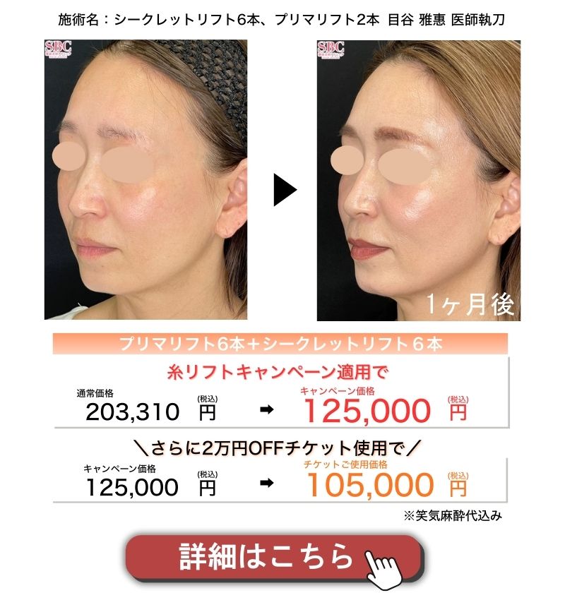 糸リフトキャンペーン