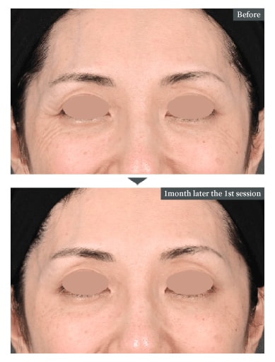 Eye Area (Inner corners, Outer corners, and Under the eyes)