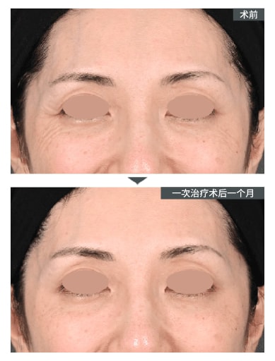 眼部（内眼角・眼角・眼睛下面）