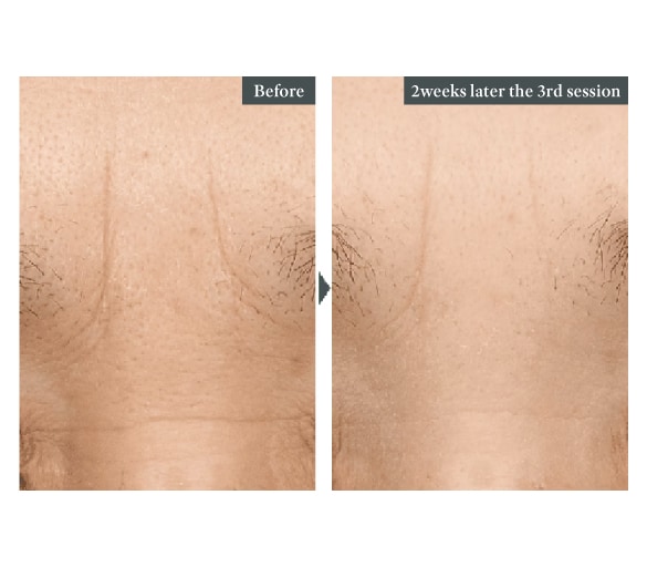 Between the eyebrows