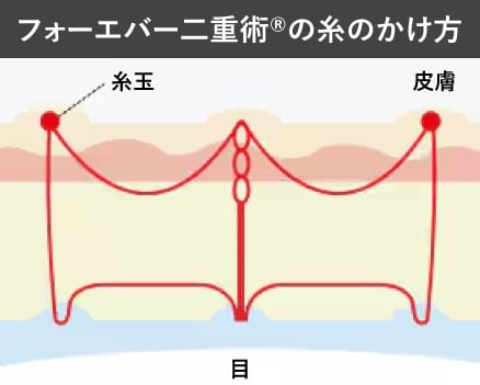 ②持続性に配慮した「フォーエバー二重術」