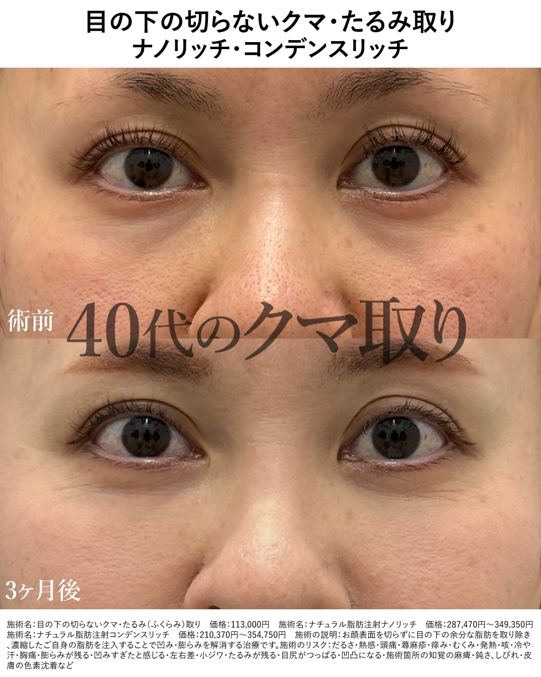 紹介ポイントをきっかけに！一生モノの「クマ取り」へ投資✨