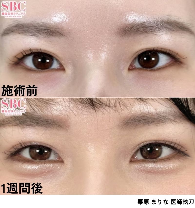 涙袋<br />
⇨うるっと垢抜けた目元に！