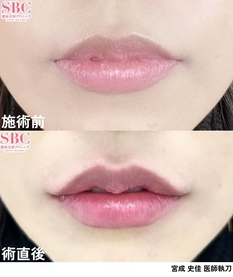 唇<br />
⇨直後から可愛いM字リップに！