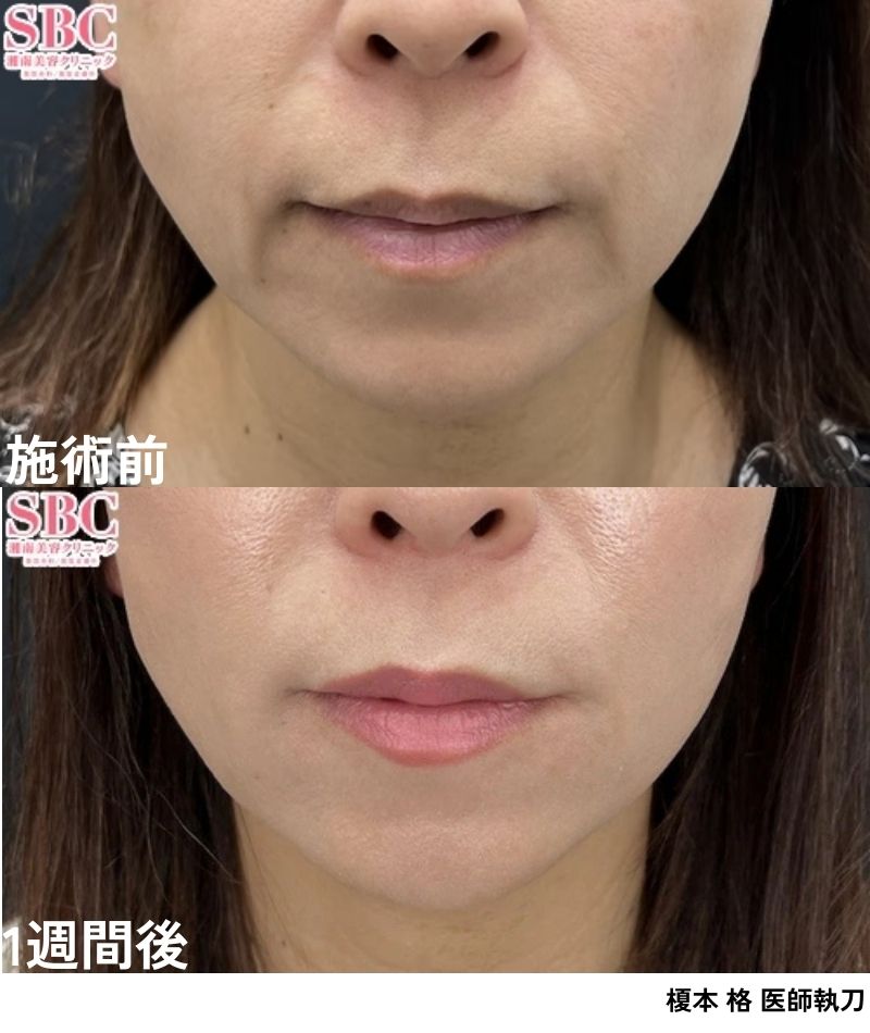 ほうれい線・マリオネットライン<br />
⇨凹みのシワが改善され若々しい印象に！