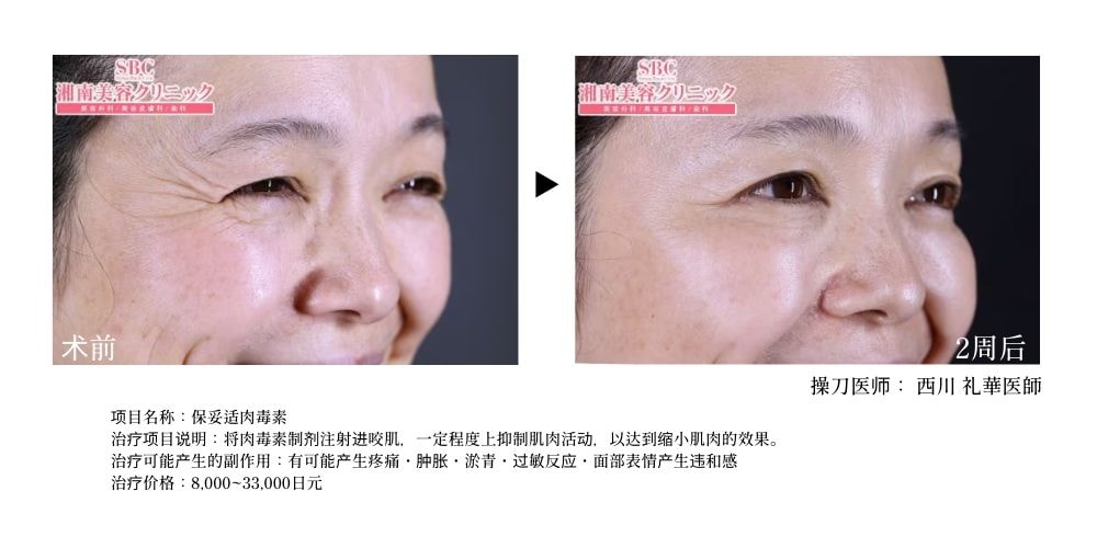 改善眼角皱纹，给人一种年轻了好几岁的感觉