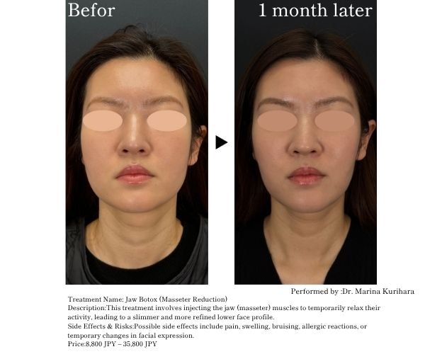 Achieve a sharper, more defined jawline with Jaw Botox.<br />
<br />
