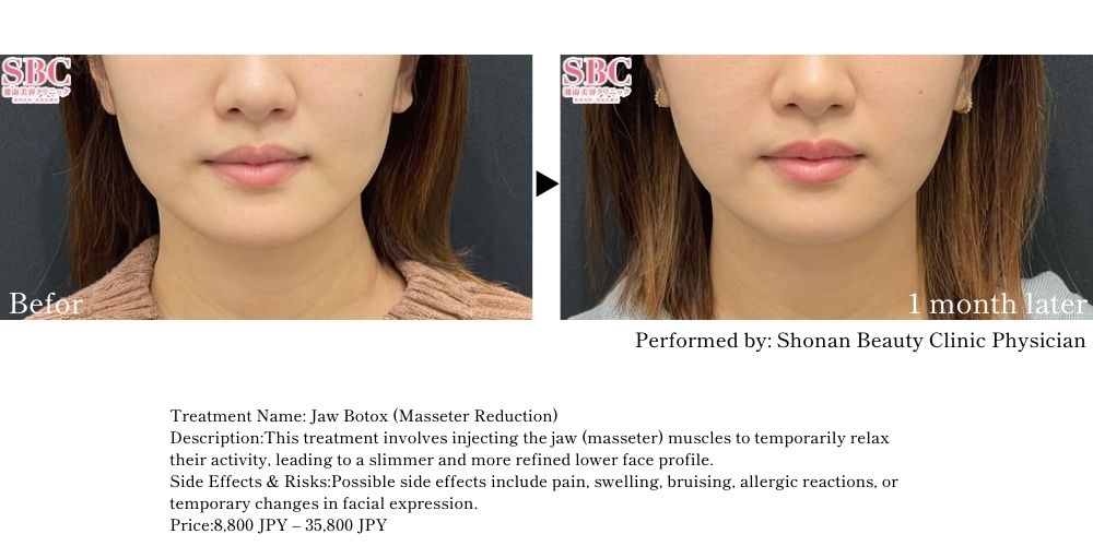 Achieve a sharper, more defined jawline with Jaw Botox.<br />
<br />
