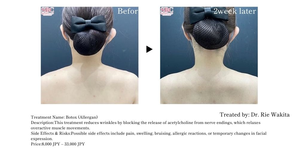 Achieve a smooth, elegant silhouette from your neck to your shoulders with Botox.