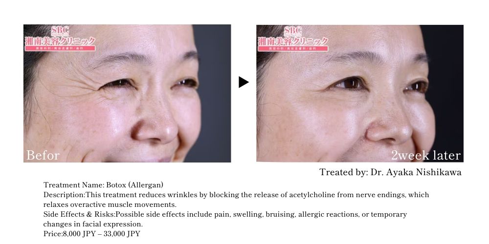 Softened crow's feet for a refreshed, rejuvenated look.