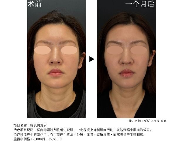注射咬肌肉毒素，面部轮廓圆滑不方正