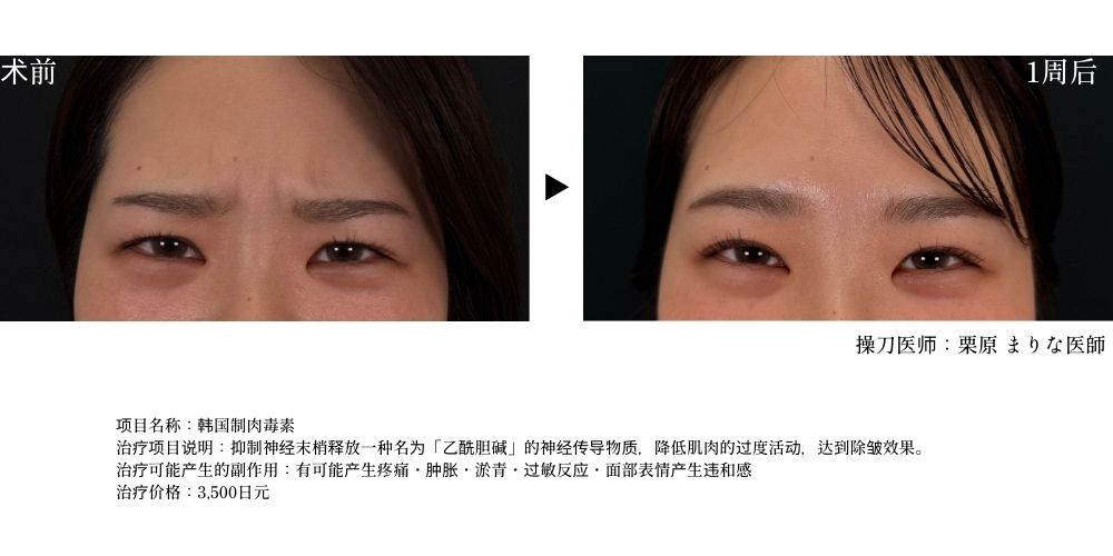 眉间注射肉毒素，达到稳重又开朗的表情