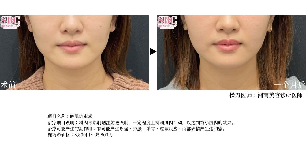 注射咬肌肉毒素，面部轮廓圆滑不方正