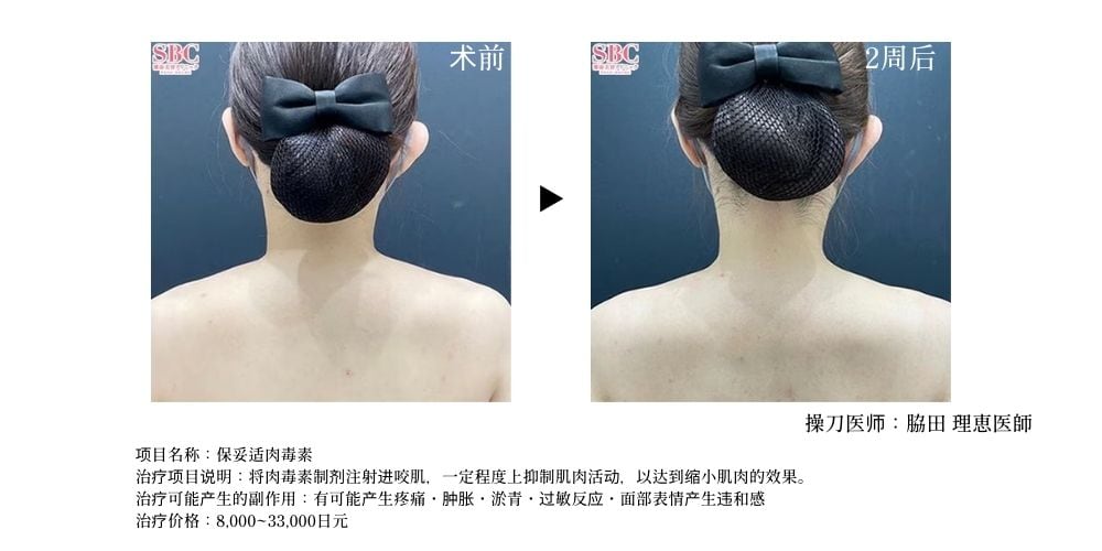 注射肩膀肉毒素，改善肩颈线条