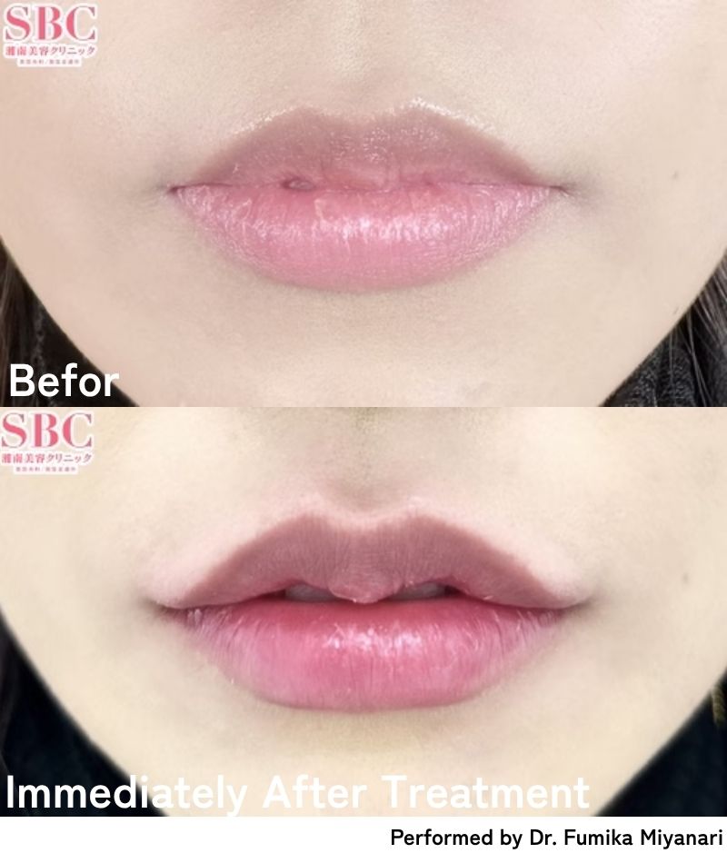 Lip Augmentation <br />
⇨Get Adorable M-Shaped Lips Instantly!
