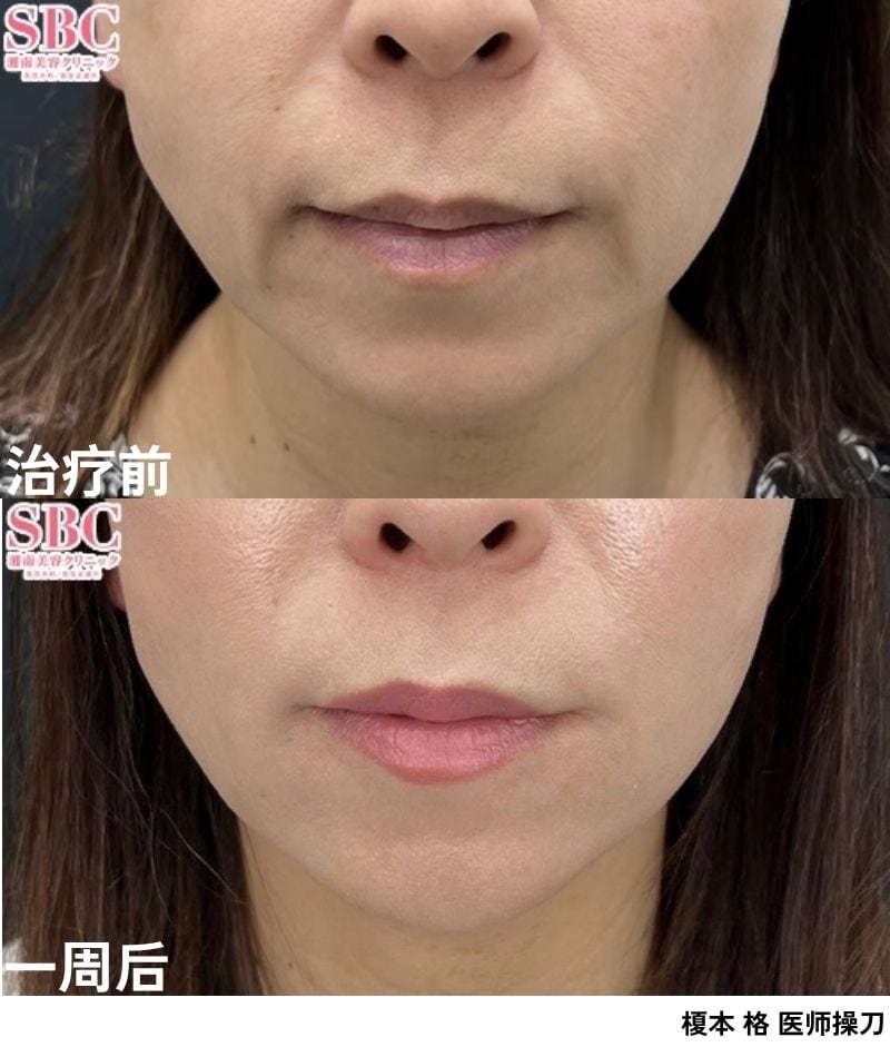 法令纹・木偶纹<br />
⇨改善凹陷性皱纹、呈现更年轻的面部印象！