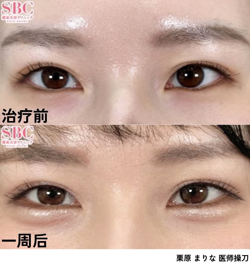 卧蚕<br />
⇨眼周水润光彩、尽显精致轮廓！