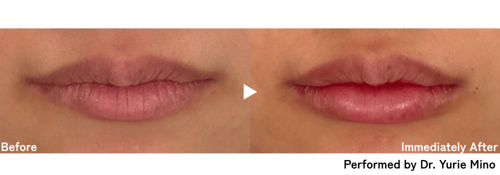 Lips