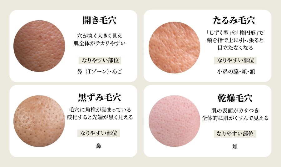 あなたの毛穴はどのタイプ？