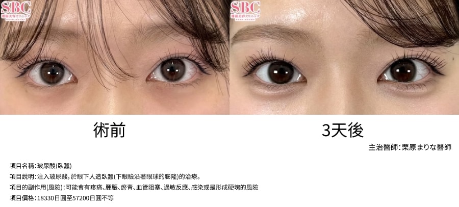 玻尿酸｜立體澎潤