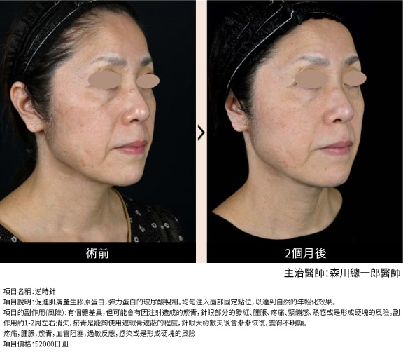 逆時針｜全臉年輕化