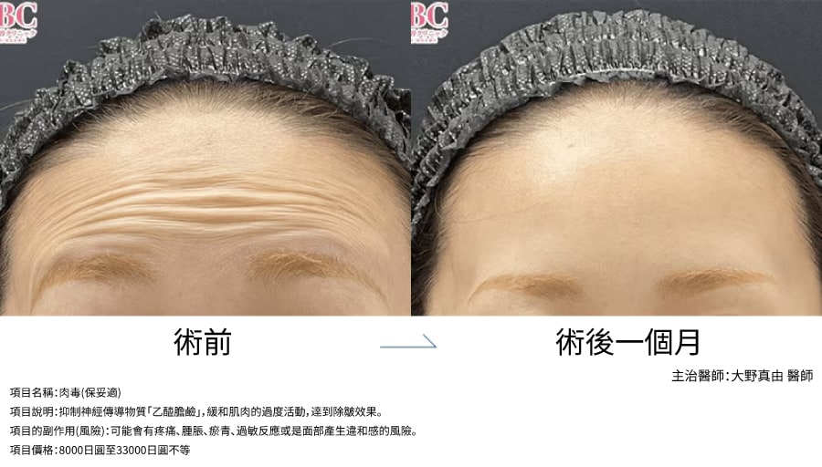 肉毒｜動態紋改善