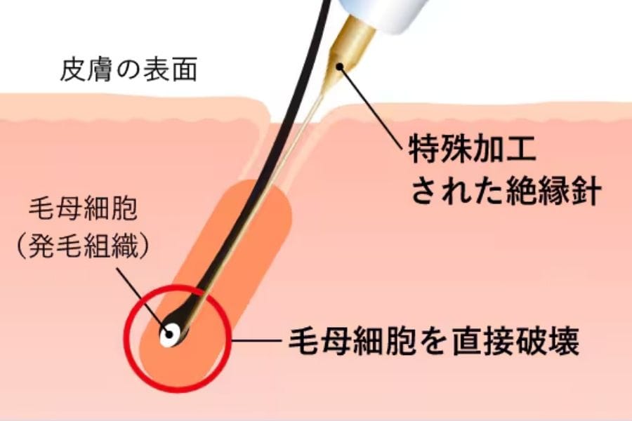 ニードル脱毛の仕組み