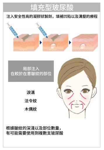 傳統填充型玻尿酸