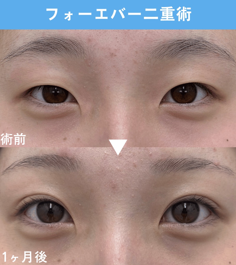 二重埋没法：10代・女性のお客様