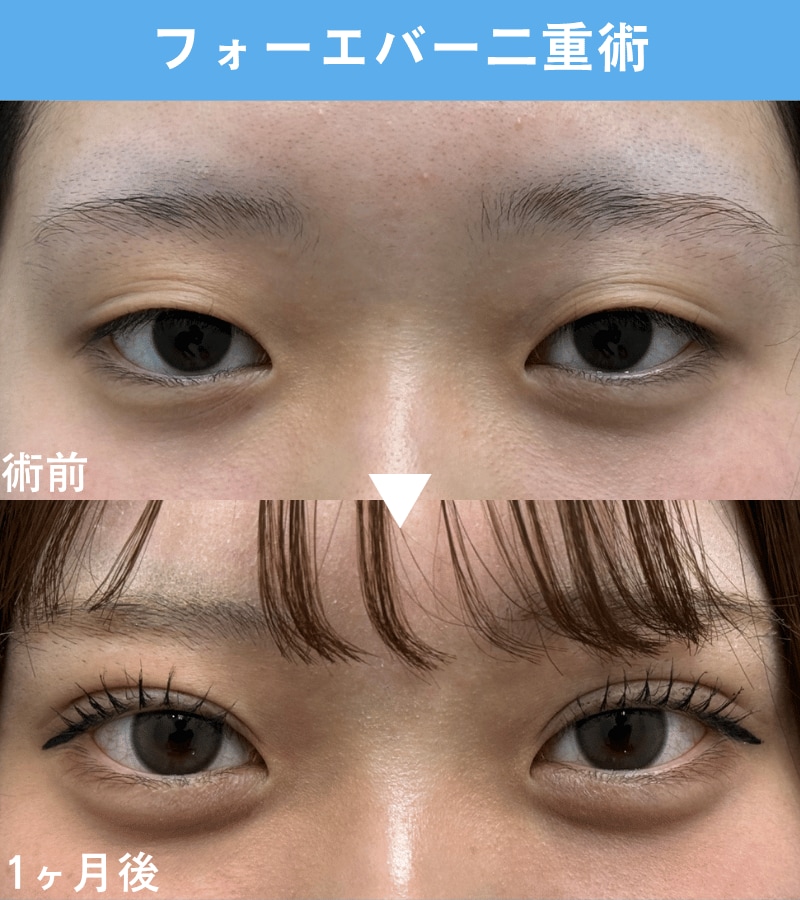 二重埋没法：10代・女性のお客様