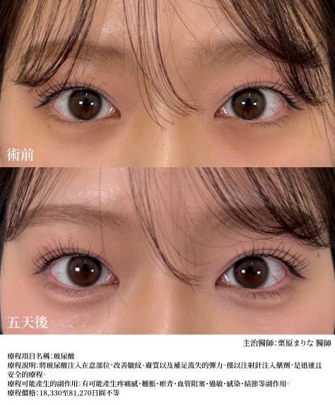 臥蠶<br />
