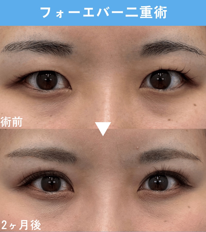 二重埋没法：20代・女性のお客様