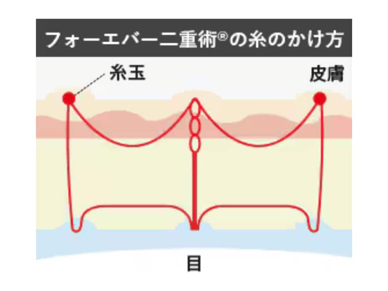 フォーエバー二重術®