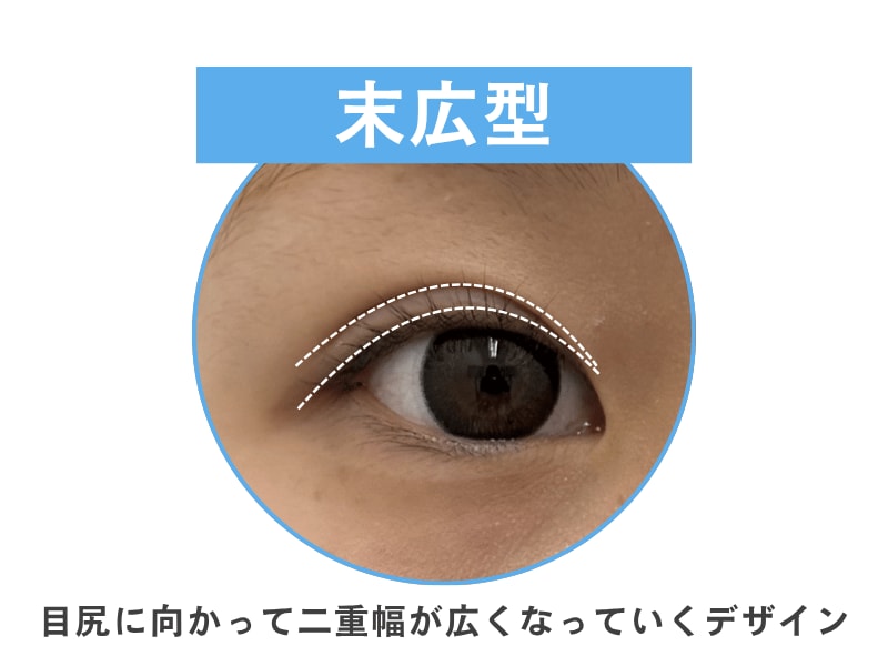 とにかく自然でバレたくない方には末広型