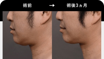 ハイフと同時に受けるとさらに効果的!<br />
おすすめメニュー
