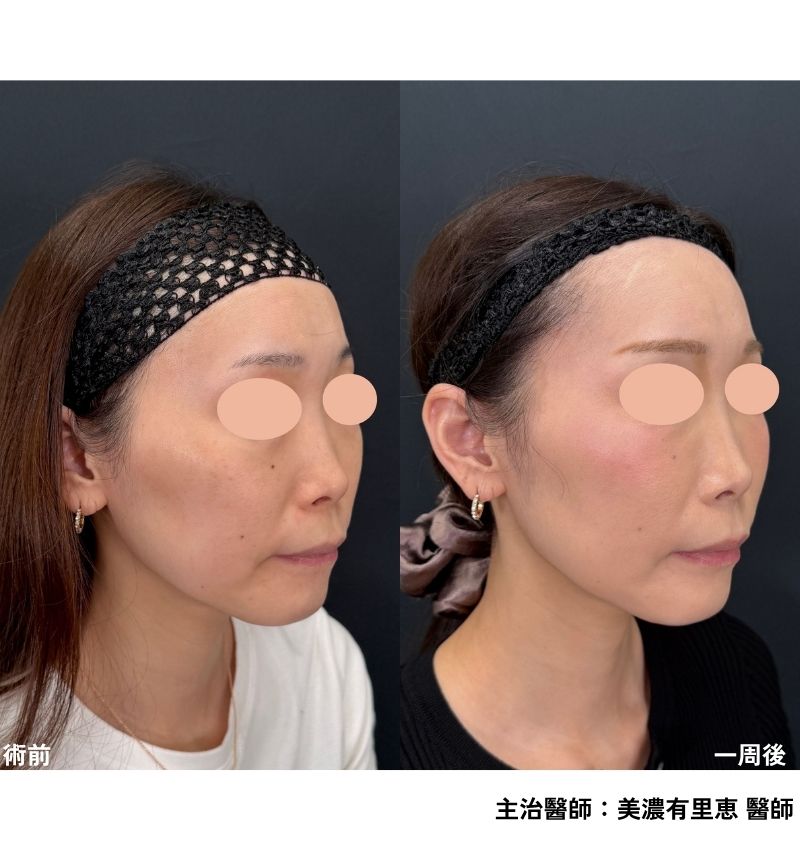 臉頰x法令紋