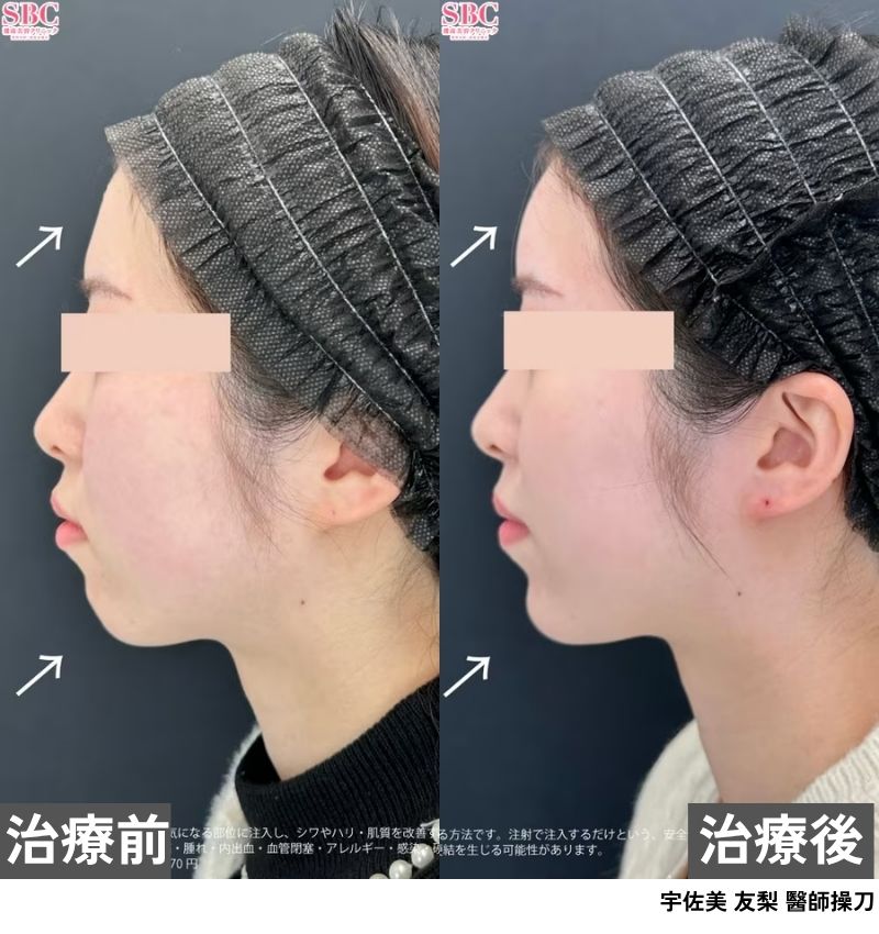 額頭・下巴<br />
⇨打造自然飽滿額頭，塑造精緻側臉E線！
