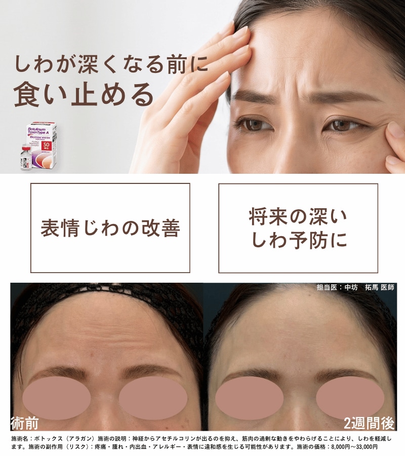 ボトックス