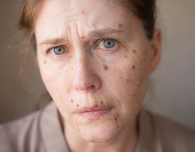 Challenges of Previous Treatments (Such as Dermapen)