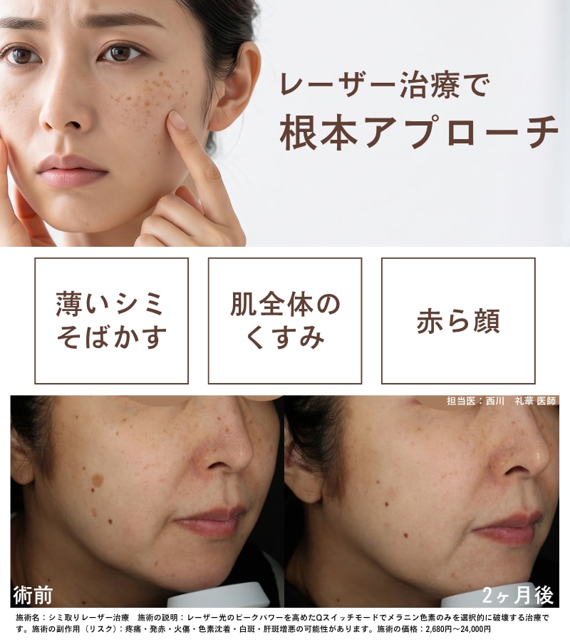 シミ取り