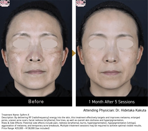 Improve Pigmentation, Redness, and Enlarged Pores.